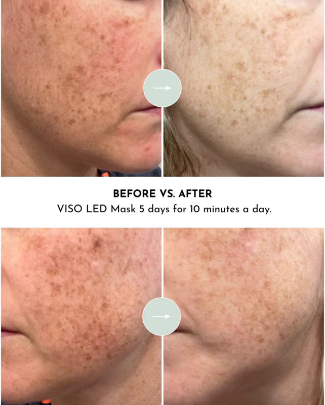 Lux Red Light Therapy Mask